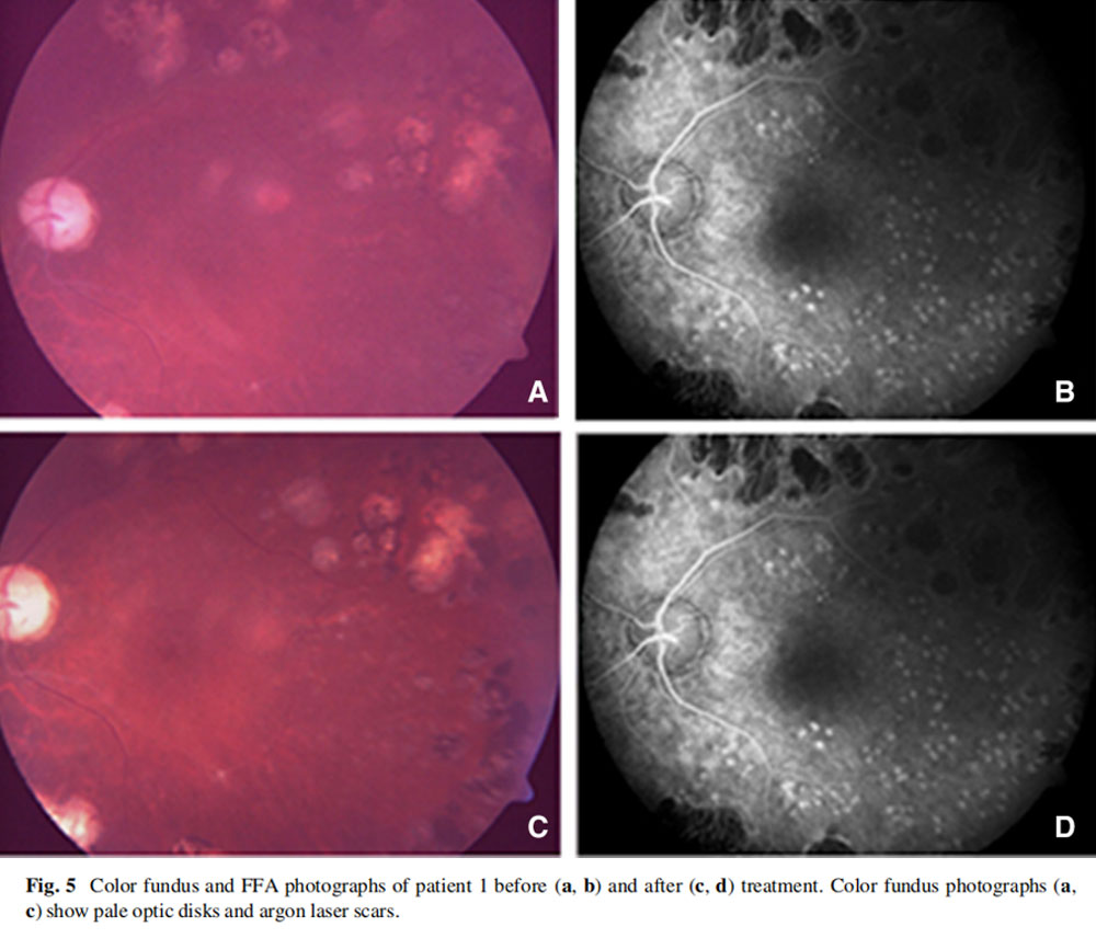 視神經萎縮臨床試驗