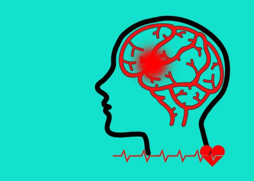 哪些中風患者適合干細胞治療？專家公布了5大評估標準