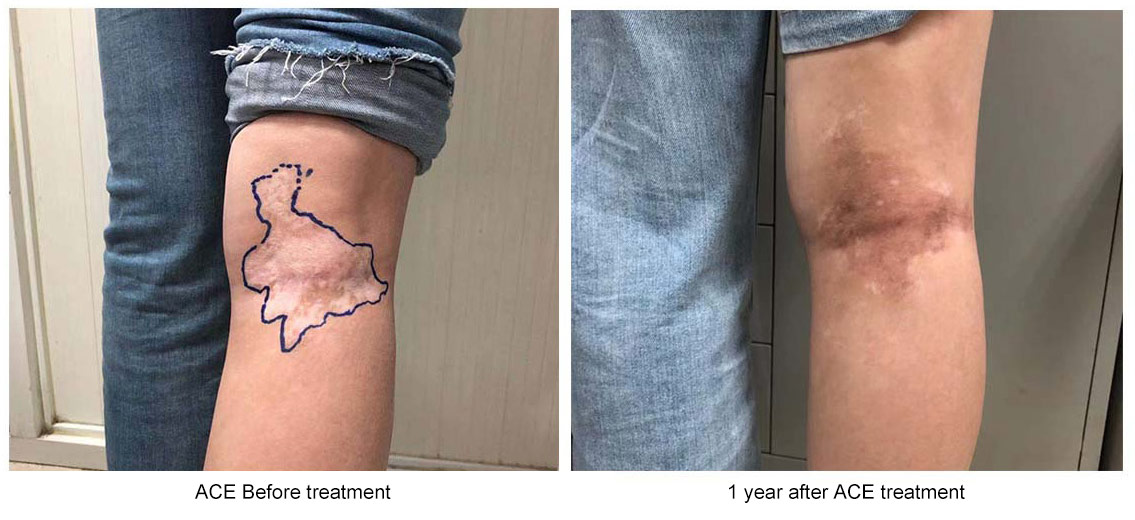 干細胞移植前后白癜風癥狀改變