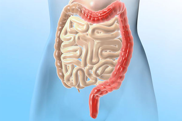 潰瘍性結(jié)腸炎新希望：干細(xì)胞移植2個(gè)月緩解率達(dá)7成，4成患者實(shí)現(xiàn)粘膜愈合