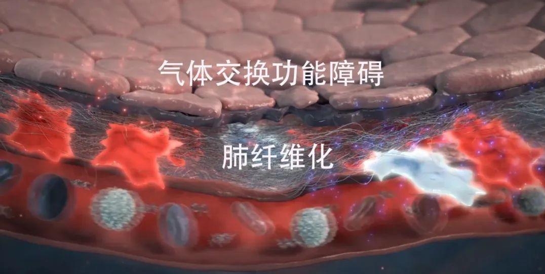 纖維化疾病 纖維化疾病