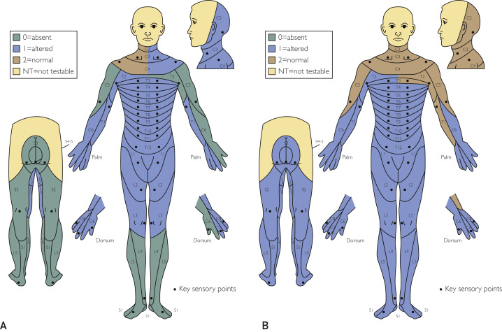圖2：根據脊髓損傷神經學分類國際標準，在基線（A）和 18 個月隨訪（B）時形成的皮節感覺評分。