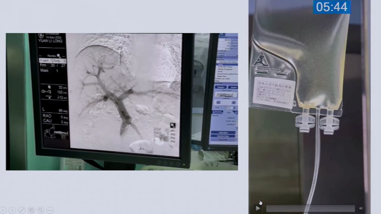 殷浩教授展示了干細胞療法的治療過程