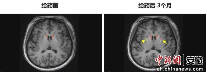 圖為李女士 PET-DAT/MRI融合圖像術前與術后三個月對比。
