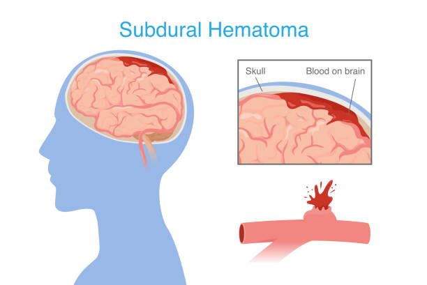 神經干細胞移植治療腦出血的系統評價：NSC來源、輸送途徑、治療機制和早期臨床試驗