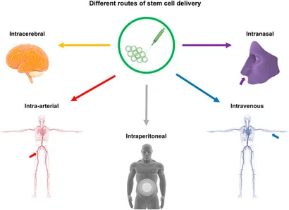 干細胞移植途徑：該圖展示了用于中風治療的干細胞輸送途徑，包括腦內（立體定向注射）、血管內（靜脈/動脈）、腹腔內、腦室內、靜脈內、鼻內和鞘內注射方法。